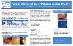 Ocular Manifestations of Psoriasis Beyond Dry Eye