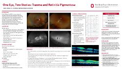 One Eye, Two Stories: Trauma and Retinitis Pigmentosa