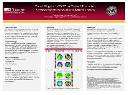 Count Fingers to 20/20: A Case of Managing Advanced Keratoconus with Scleral Lenses