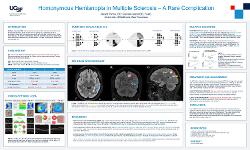 Homonymous Hemianopia in Multiple Sclerosis - A Rare Complication