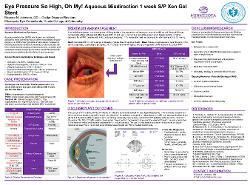 Eye pressure so high, oh my! Aqueous misdirection one week s/p Xen gel stent.