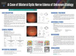 A Case of Bilateral Optic Nerve Edema with Unknown Etiology