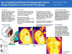 Use of Irrigating Eyelid Retractor in Management of Acute Allergic Conjunctivitis