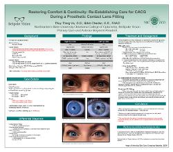 Restoring Comfort & Continuity: Re-establishing Care for CACG During a Prosthetic Contact Lens Fitting for a Mydriatic Pupil Causing Glare & Headaches
