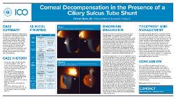 Corneal Decompensation in the presence of a Ciliary Sulcus Tube Shunt