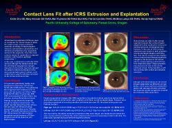 Scleral lens fit after ICRS extrusion and explantation