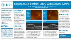 Simultaneous Bilateral BRVO with Macular Edema
