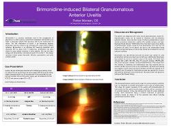 Brimonidine induced Bilateral Acute Anterior Granulomatous Uveitis