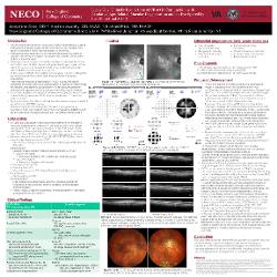 Lucky Guy, Unlucky Eye: A Case of CRAO in Conjunction with Exudative Age-Related Macular Degeneration and an Eye Spared by the Cilioretinal Artery