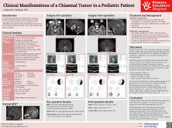 Clinical Manifestations of a Chiasmal Tumor in a Pediatric Patient
