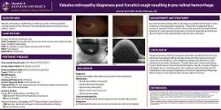Valsalva retinopathy diagnoses post forceful cough resulting in pre-retinal hemorrhage