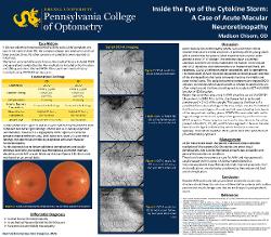 Inside the Eye of the Cytokine Storm: A Case of Acute Macular Neuroretinopathy