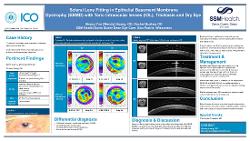 Scleral Lens Fitting in Epithelial Basement Membrane Dystrophy (EBMD) with Toric Intraocular lenses (IOL), Trichiasis and Dry Eye