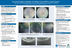 The Great Debate on Exudate: A Pediatric Case of FEVR vs. Coat's Disease