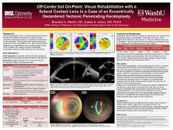 Off-Center but On Point: Visual Rehabilitation with a Scleral Contact Lens in a Case of an Eccentrically Decentered Tectonic Penetrating Keratoplasty
