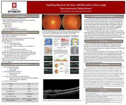 Swelling Beyond the Disc: NAION with a Rare Large Neurosensory Detachment